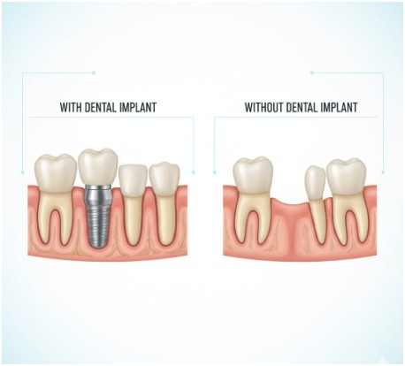 Protection For Adjacent Teeth