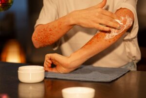 Signs Your Eczema Needs Professional Treatment