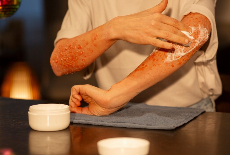 Signs Your Eczema Needs Professional Treatment