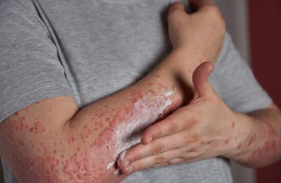 The Itching Is Severe or Constant